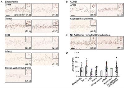 Hippocampal ΔFosB expression is associated with cognitive impairment in a subgroup of patients with childhood epilepsies